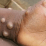 mpox